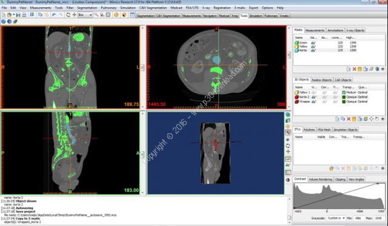 Materialise Mimics Innovation Suite Medical / Research v20.0 x64 Crack